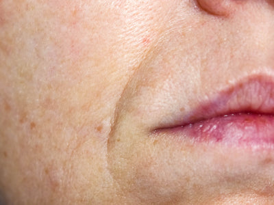 microneedling for smile lines