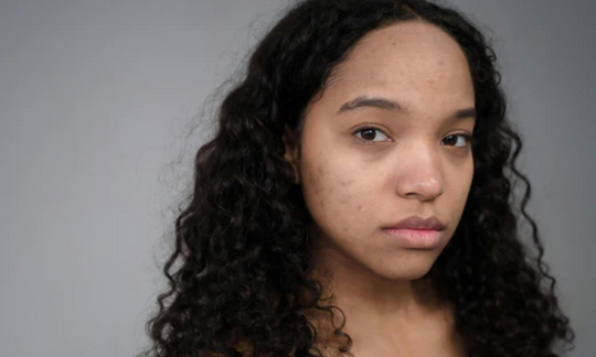 microneedling for acne scars