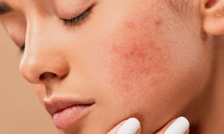 How to Stop Breakouts in Your Period