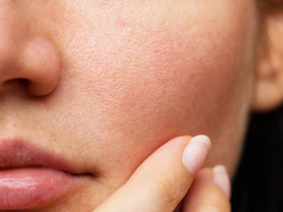 is blue light or red light better for acne