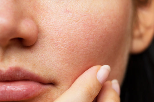 is blue light or red light better for acne