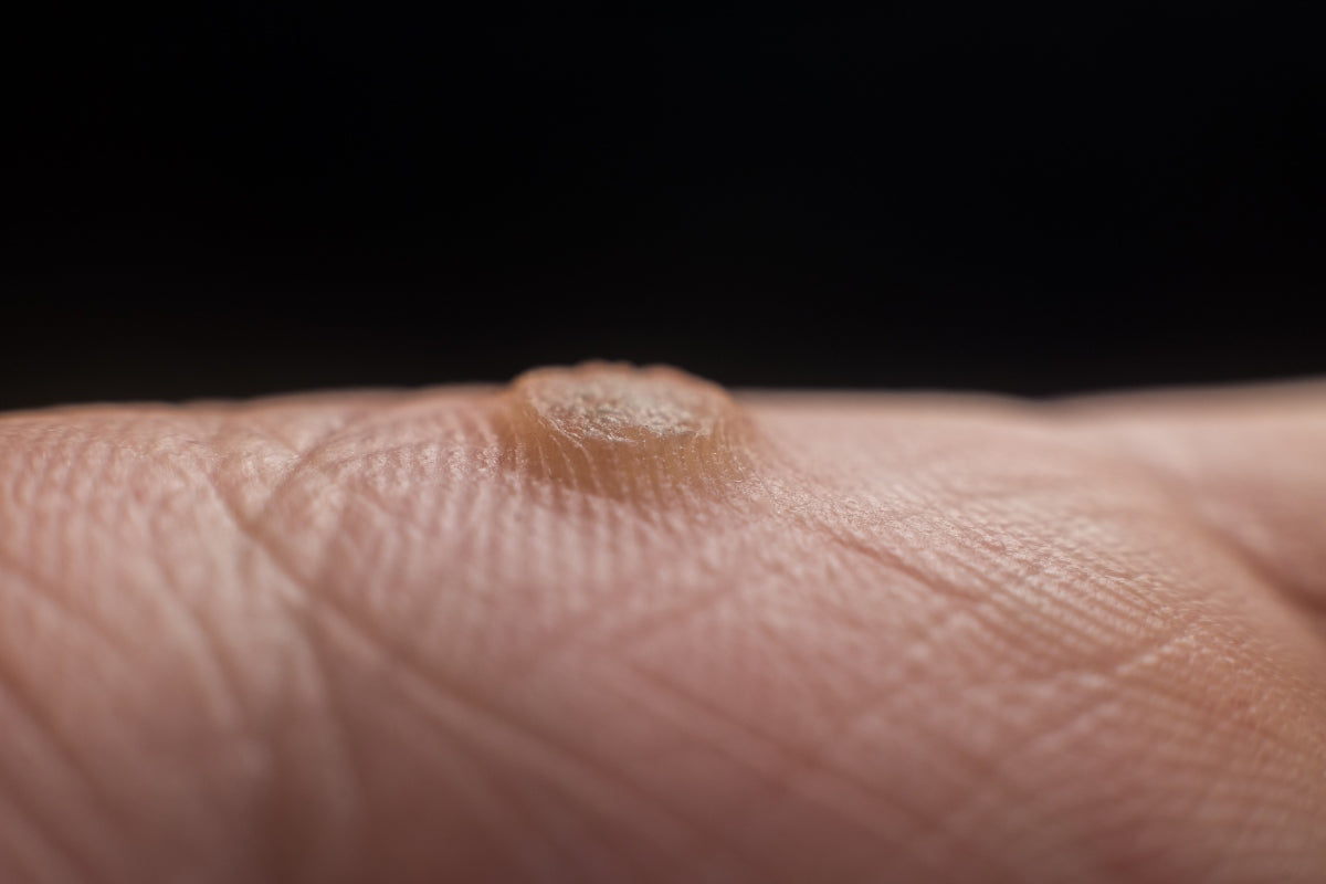 red light therapy warts