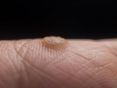 red light therapy warts