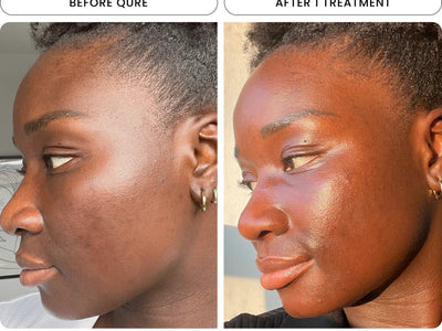 microneedling black skin