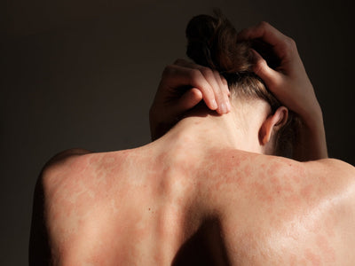 red light therapy for psoriasis