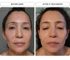 Micro-Infusion (Dark Spots) (2 Refill Treatments)