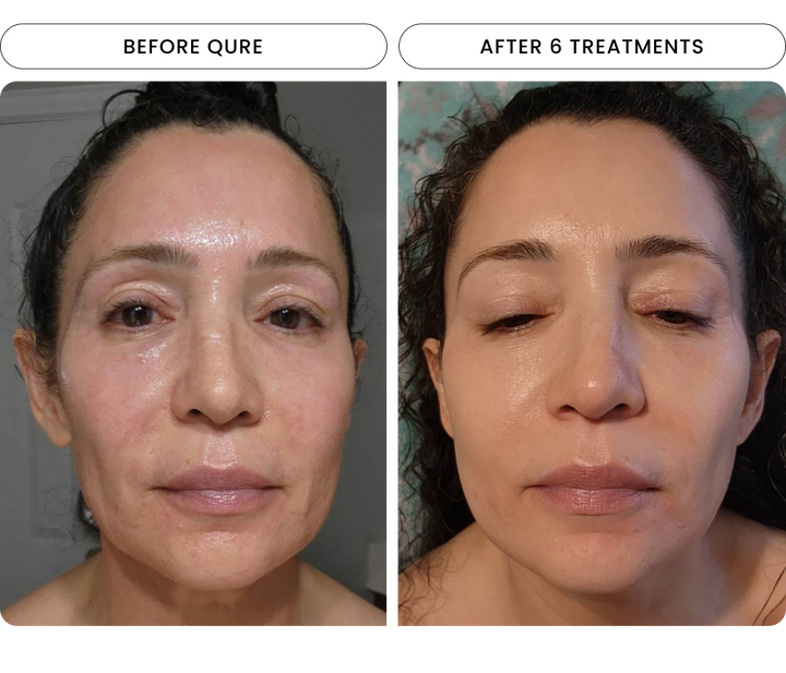 Micro-Infusion (Dark Spots) (2 Refill Treatments)