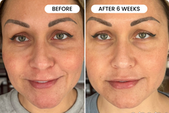 Micro-Infusion 1 Month Bundle (For Wrinkles + Dark Spots)