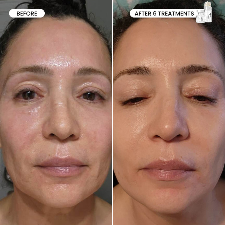 Micro-Infusion 3 Month Bundle (For Wrinkles)