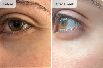 wrinkles reduced after one week.