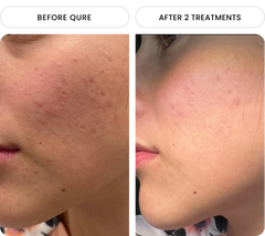 mi_acne4