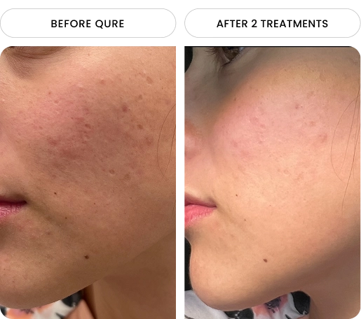mi_acne4