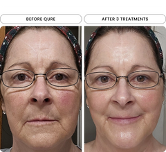 Micro-Infusion 6 Month (For Wrinkles + Dark Spots) sku