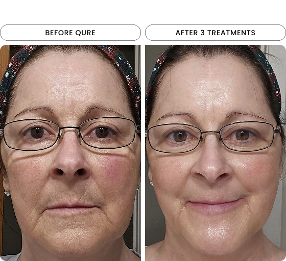 Micro-Infusion 6 Month (For Wrinkles + Dark Spots) sku