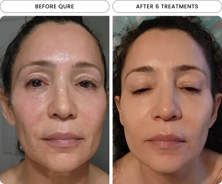 Micro-Infusion 6 Month Bundle (For Wrinkles)