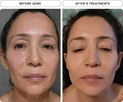 Micro-Infusion 6 Month (For Wrinkles + Dark Spots) sku