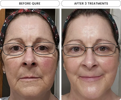 Micro-Infusion 6 Month Bundle (For Wrinkles)