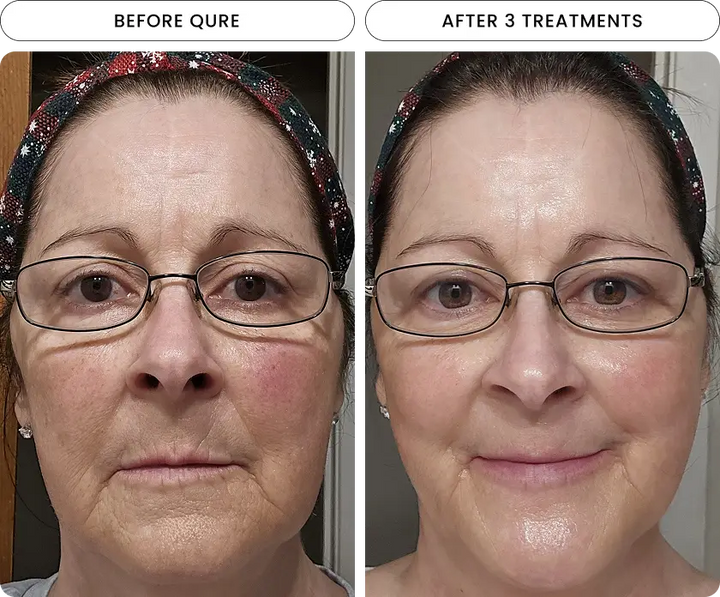 Micro-Infusion 6 Month Bundle (For Wrinkles)